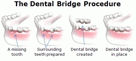 Dental Bridges Dentists | Bridges | Marion IL