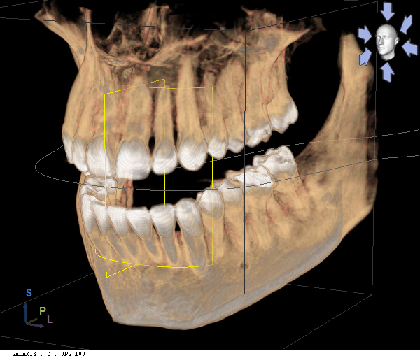 Oral Surgery | Teeth Extractions | Marion IL