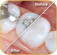 White Fillings Dental Services | dentists | Marion IL