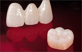 Dental Crowns | Dentists | Marion IL
