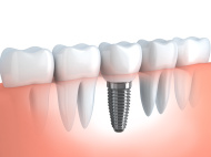 Teeth Replacement | Marion IL