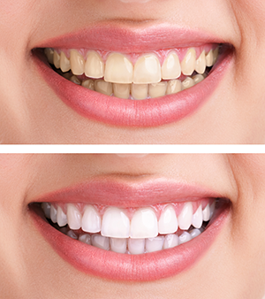 Dental Cleaning | Dentists | Marion IL